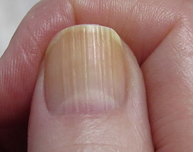 Vertical Lines on Nails