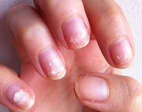 Damages by Acrylic, Artificial Nails or Nail Arts